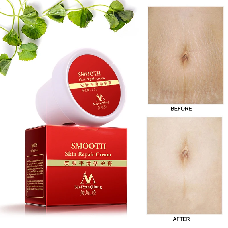 

MeiYanQiong Precious Skin Body Cream Stretch Marks Remover And Scar Removal Postpartum Obesity Pregnancy Face Cream