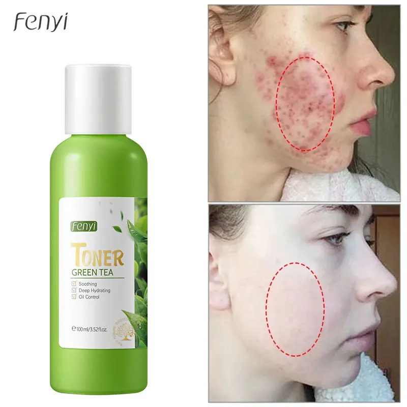 

Green Tea Acne Removal Face Toner Shrink Pores Oil Control Serum Fade Fine Lines Whitening Moisturizer Nourish Korean Cosmetics
