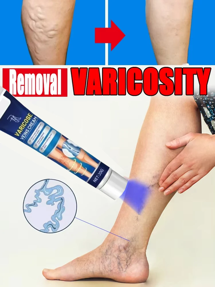 Новый ремонт варикозного расширения вен эффективный язык снимает выпуклость ног