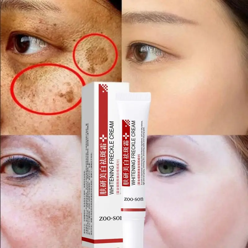 

Whitening Freckle Cream Remove Dark Spots Anti Freckle Face Creams Niacinamide Fade Pigmentation Melasma Brighten Skin Care 20g