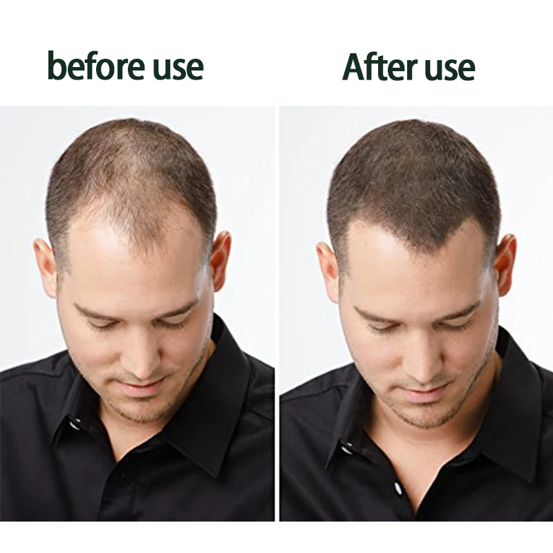 YOUNGCOME 60g 5 Days Hair Growth Ointment Promote Blood Circulation Protect Loss Control Oil Products |