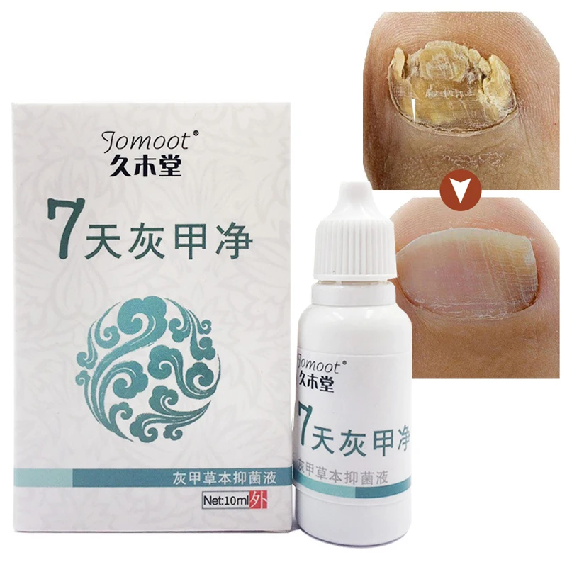

7 Days Effective Fungus Nail Treatment Anti Fungal Serum Essence Remove Paronychia Onychomycosis Infection Foot Toe Nails Repair