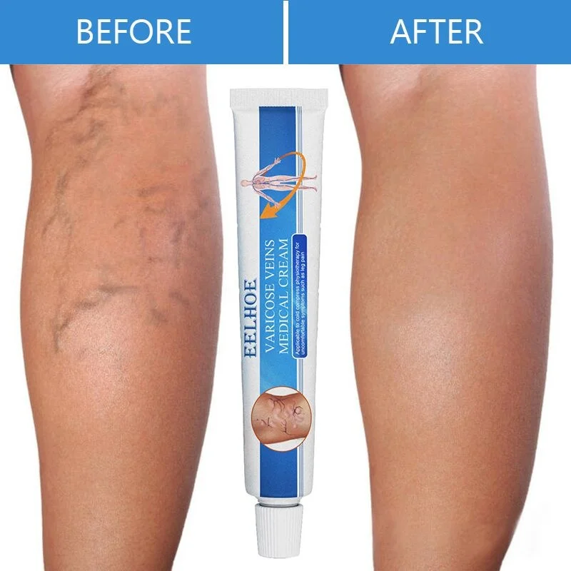 

Herbal Varicose Veins Treatment Cream Relieve Tired Legs Dilated Vasculitis Phlebitis Spider Pain Relief Ointment Body Care 20g