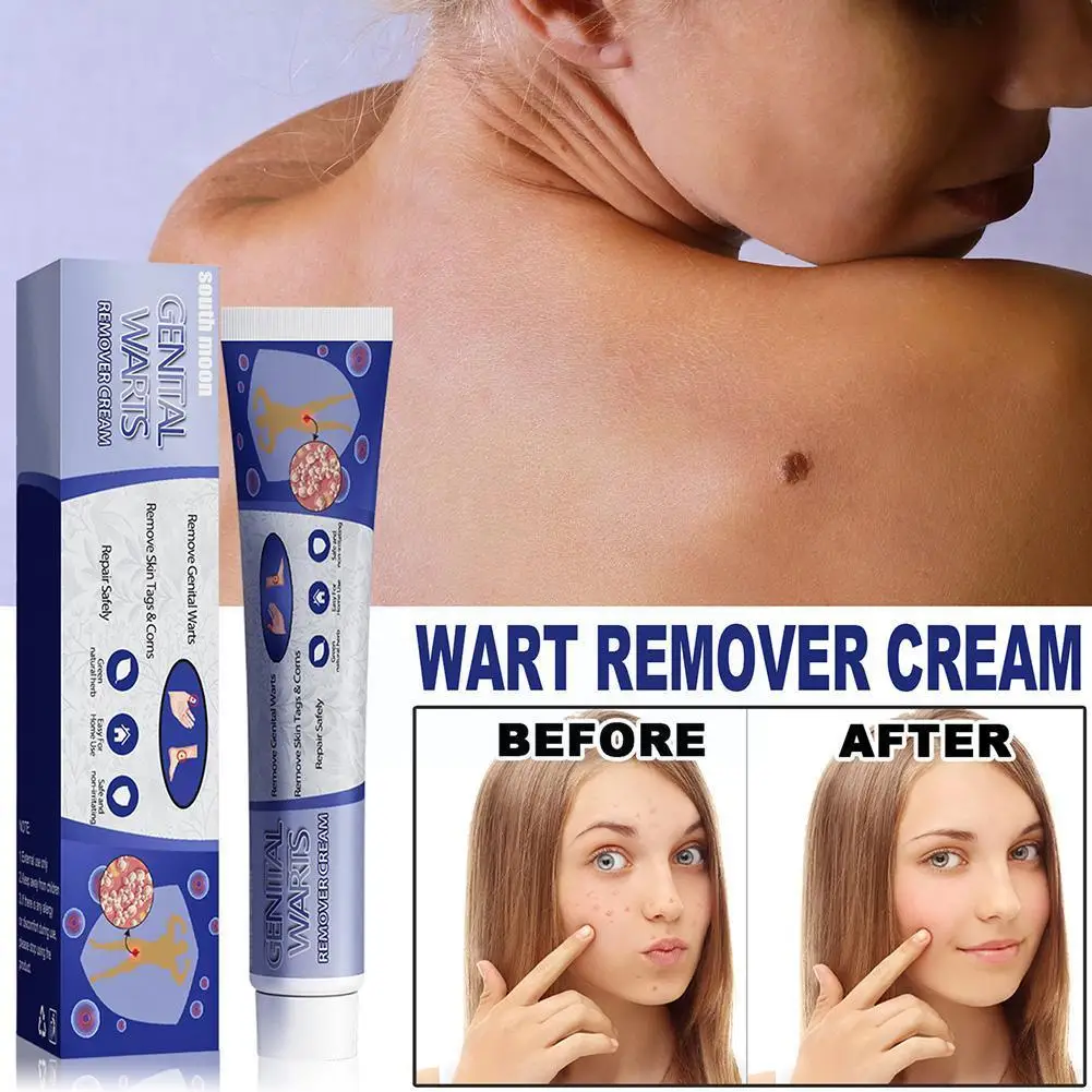 

Warts Remover Ointment Cream Skin Tags Removal Gel Body Treatment Remover Removal Warts Wart Body Face Mole Care P6K6