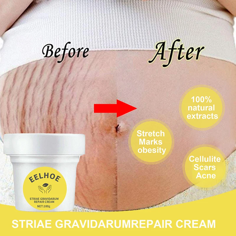 

Skin Care Cream Thailand Pasjel Precious Body Removal Repair Patch Scar Removal Postpartum Obesity Pregnancy Cream