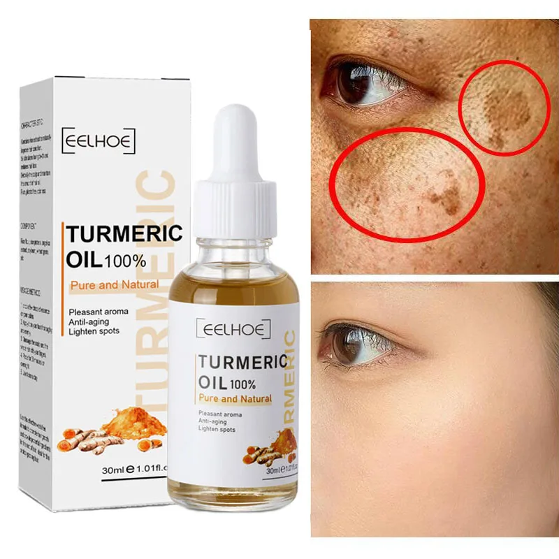 Turmeric Freckle Whitening Face Serum Brighten Fade Dark Spots Removal Melasma Pigment Melanin Anti-Aging Beauty Skin Care 30ml