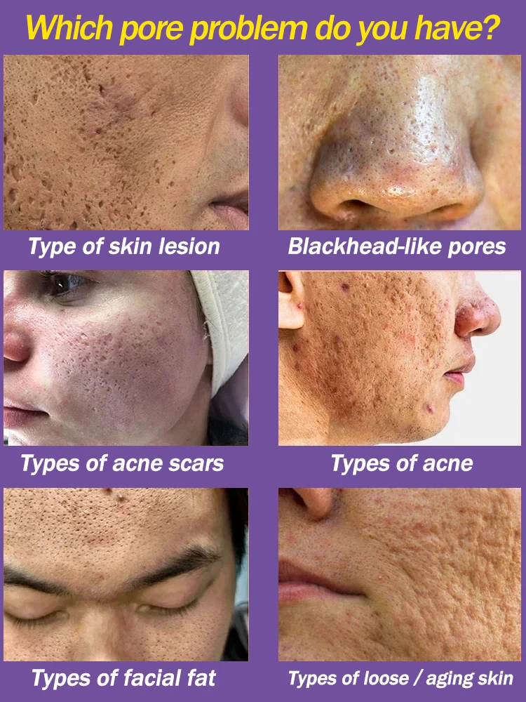 Сыворотка для сужения пор с салициловой кислотой быстрое удаление пятен гладкой