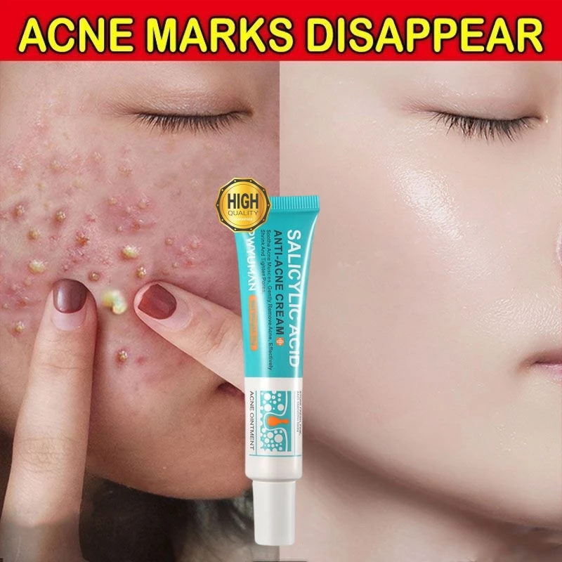 

Salicylic Acid Acne Removal Cream Shrinking Pores Anti Pimples Smooth Gently Repair Oil Control Moisturizing Whitening Skin Care