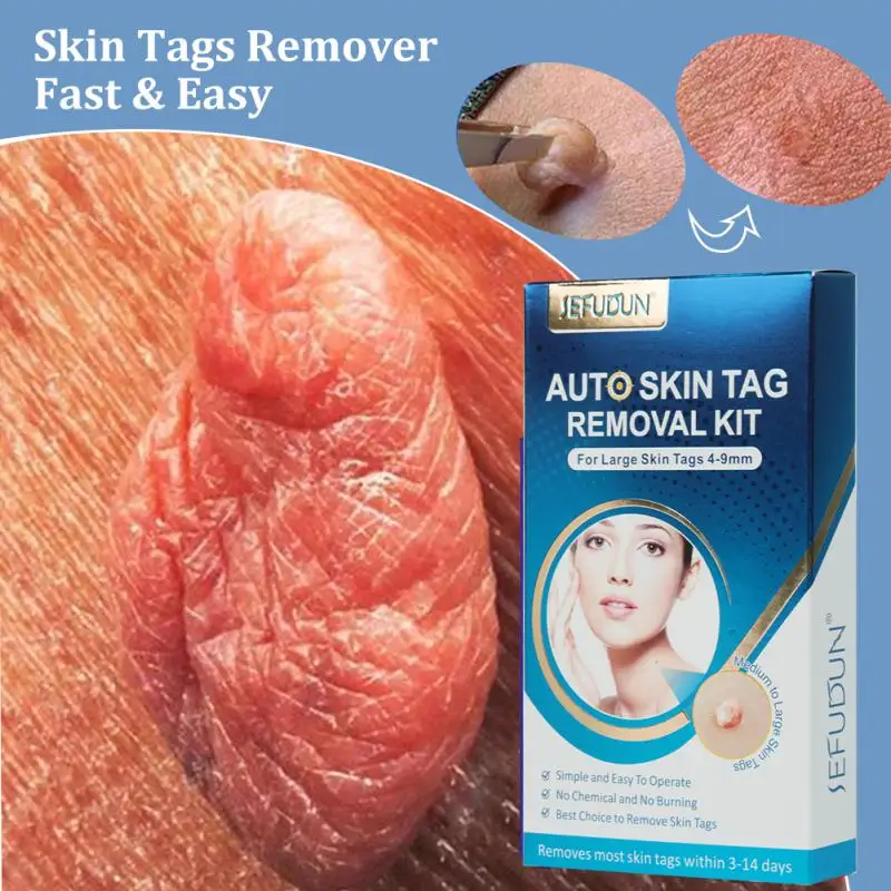 

Skin Label Removal Pen Remover Micro Skin Tag Remover Skin Mole Wart Remover Micro Removal Kit With Cleansing Swabs Adult Mole