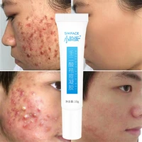 azelaic acid acne cream remove acnes pimples whiten dark spot scars anti acne treatment gel shrink pores oil control face care