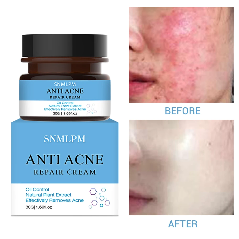 

Effective Acne Removal Cream Acne Fade Acne Spots Oil Control Acne Cream Skin Care Repair Moisturizing Face Gel Skin Care 30g