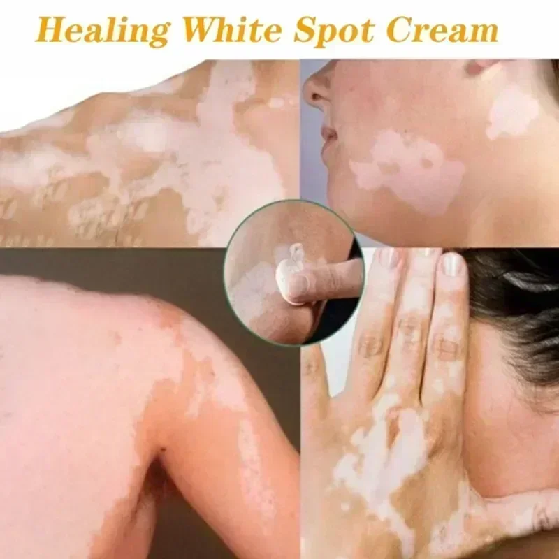 Волшебный инструмент Newvitiligo