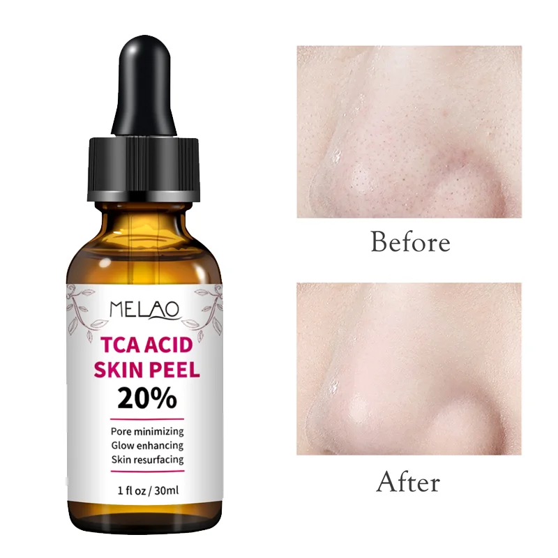 

20% Tca Acid Skin Peel 30ML Natural Skin Care Face Serum Pore Minimizing Glow Enhancing Reduce Blackhead With Salicylic Acid