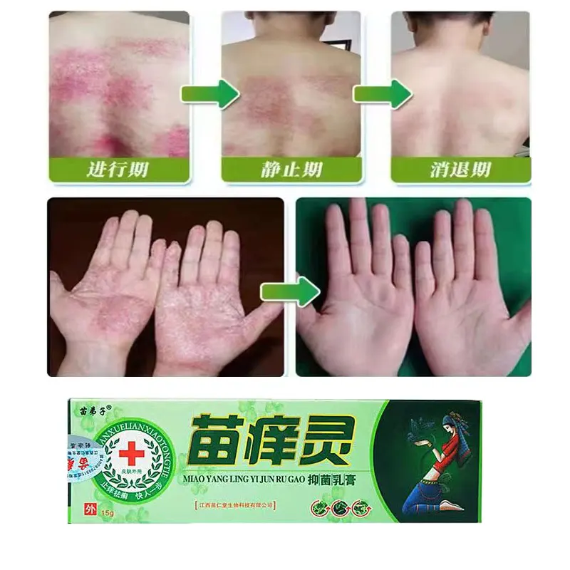 

Травяной эффективный Антибактериальный полезный крем от псориаза и дерматита