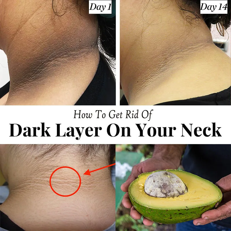 

Exfoliating Body Scrub Solution for Dark Neck Avocado Extract Hyperpigmentation Remover Vitamin C Exfoliator Bright Lighten Skin