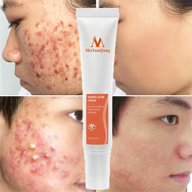 

Effective Acne Removal Cream Herbal Anti-Acne Repair Acne Scar Spots Oil Control Shrink Pores Whitening Moisturiz Face Skin Care