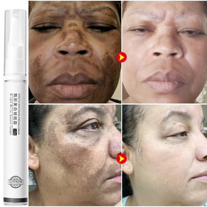 Whitening Freckles Cream Removes Face Dark Spots Lighten Melasma Blemish Pigment Removal Moisturizing Korean Skin Care Products