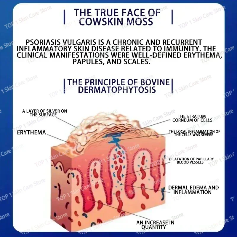 Лидер продаж крем для удаления псориаза экземы лучшие средства против дерматита