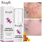 Отбеливающая Сыворотка от акне и рубцов с прополисом