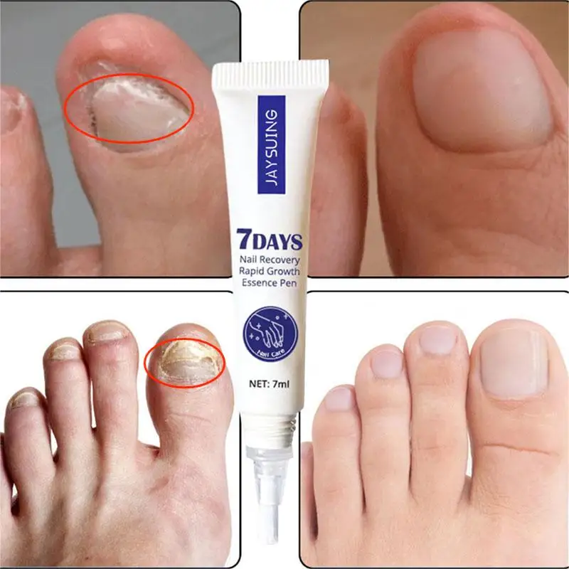

7 Days Nail Fungus Treatment Serum Toe Anti-fungal Essence Infection Paronychia Onychomycosis Removal Repairs Solution Foot Care