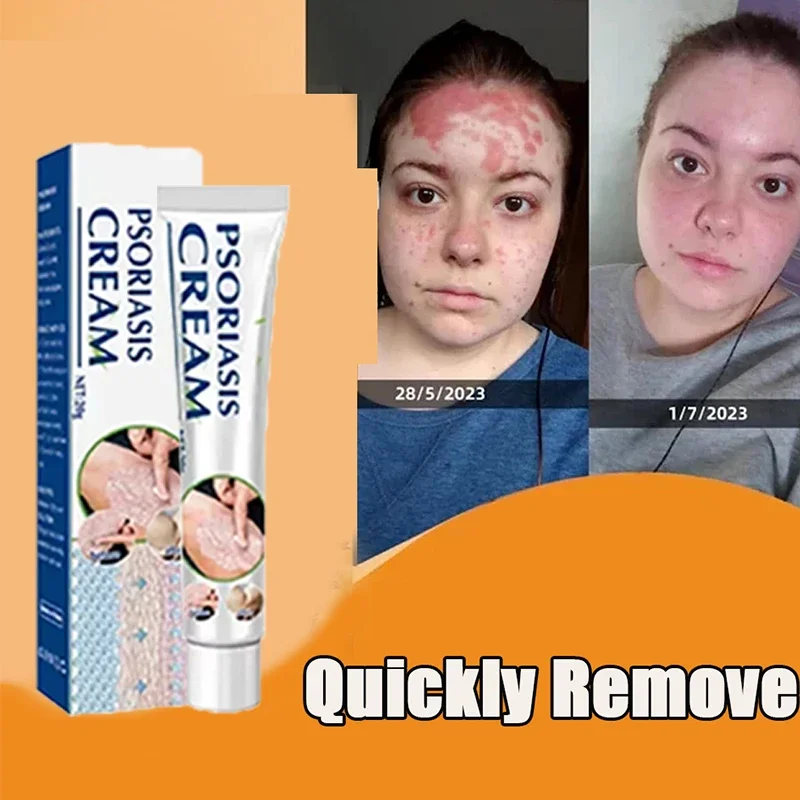 Псориаз дерматит экзема гадание грибка против зуда успокаивающий местный крем