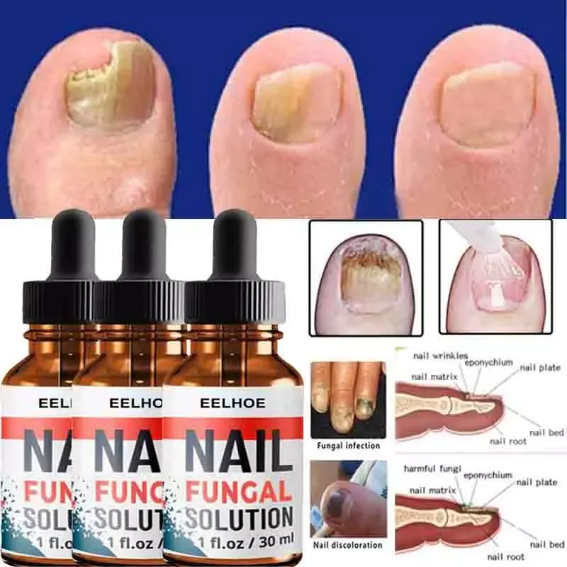 

2023NEW Repair Serum Nail Fungal Treatment Serum Onychomycosis Paronychia Anti-Fungal Nail Infection Toe Fungus Foot Repair Ca