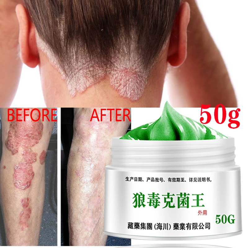 

Psoriasis Dermatitis Eczematoid Eczema Ointment Anti-Itch Chinese Herb Medical Skin Care Cream Treatment of Psoriasis