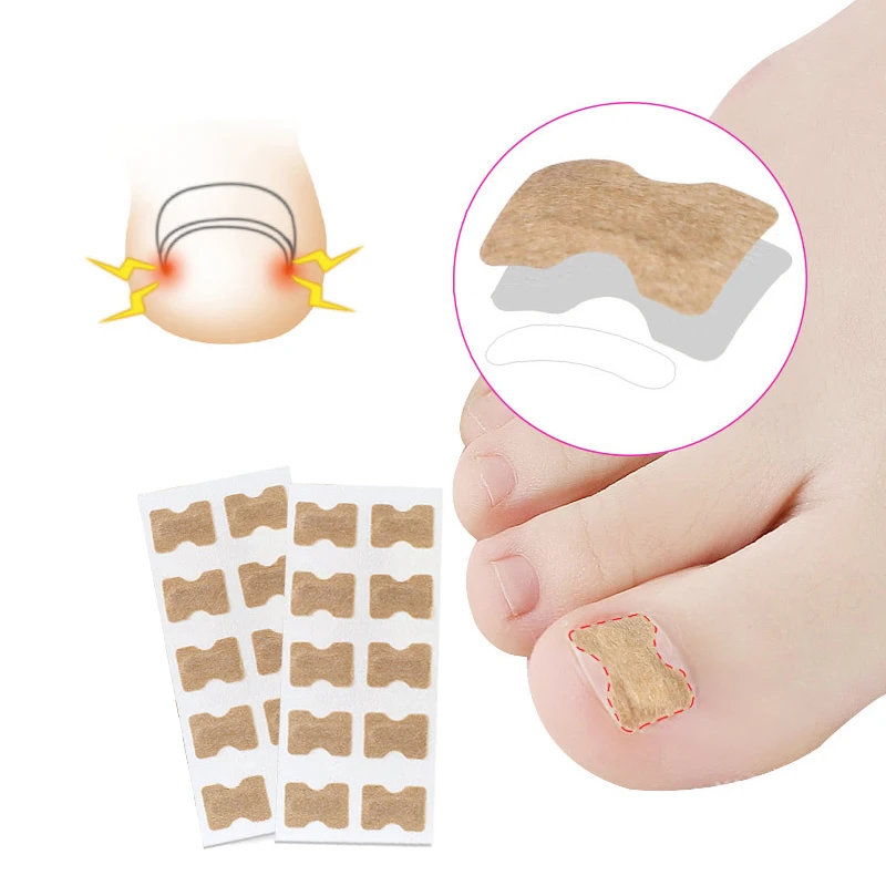 

Ingrown Toenail Corrector Sticker Nail Strip Anti-roll Nail Free Glue Toe Inlay Nail Corrector Patch Correction Stickers Toenail