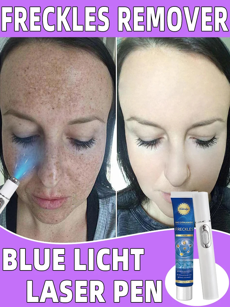 Лазерные веснушки хлоазма солнце темный возраст чистые пятна