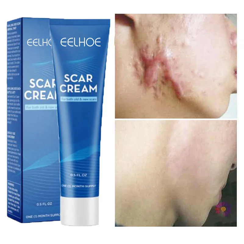 

Herbal Scar Removal Cream Repair Face Body Stretch Marks Burn Surgical Old Scars Moisturizing Smoothing Skin Care