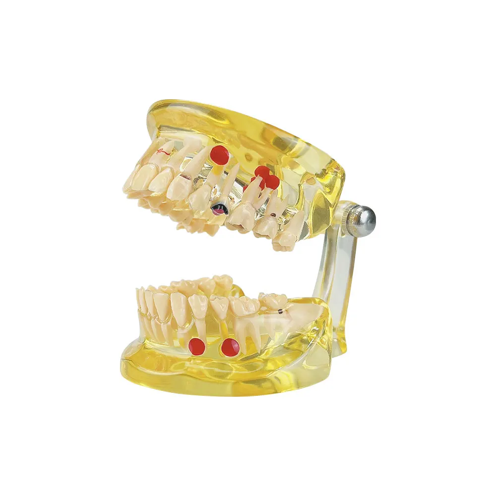 Модель для обучения стоматологии полусъемные зубы патологическая модель