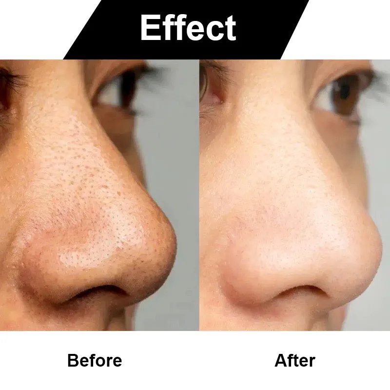 Средство для удаления черных точек с камерой электрическое средство прыщей