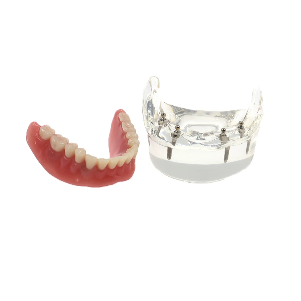 

Dental Implant Teeth Model Demo Overdenture Restoration with 4Lower Implants
