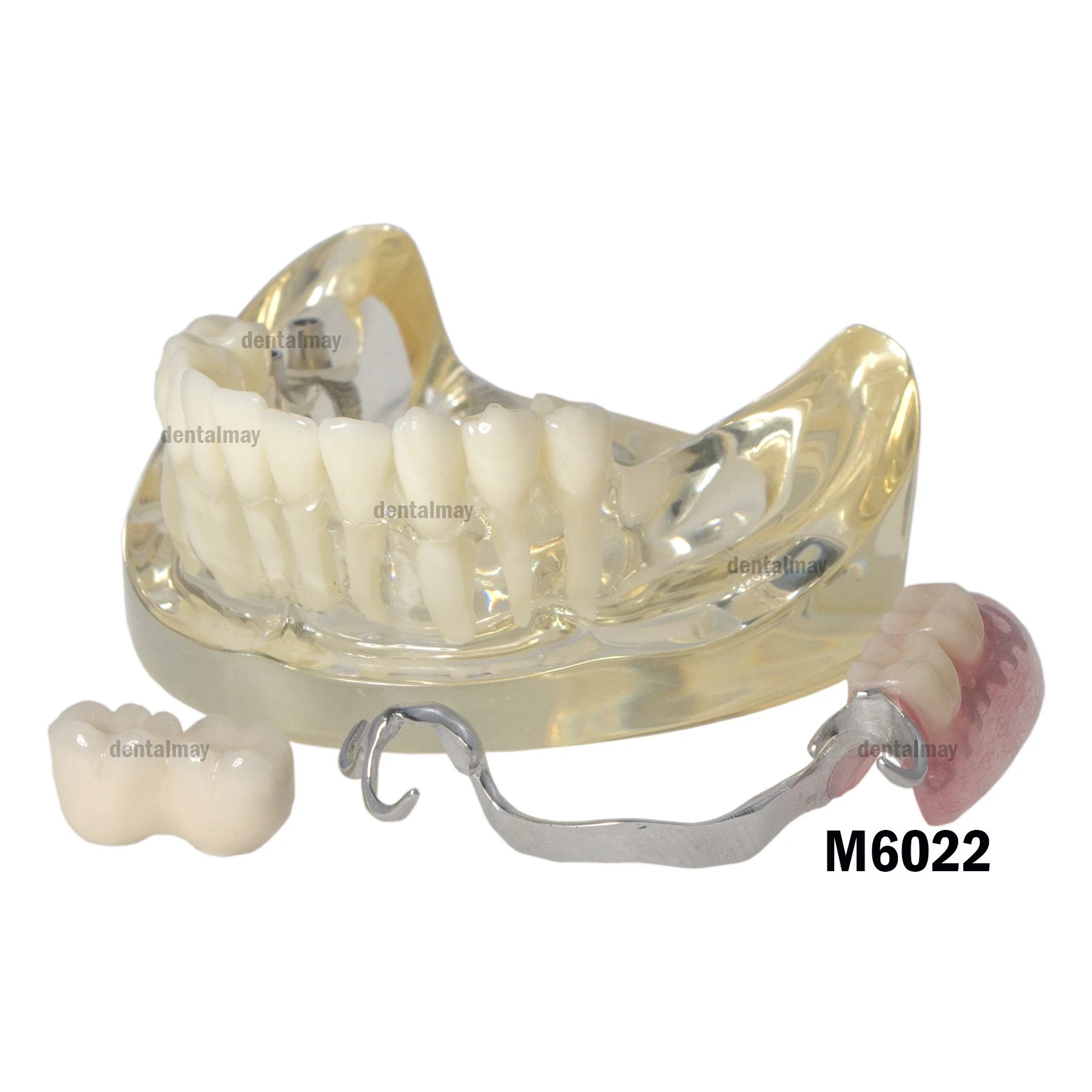 Реставрация зубного имплантата Модель зубов Typodont с частичным зубным протезом M6022