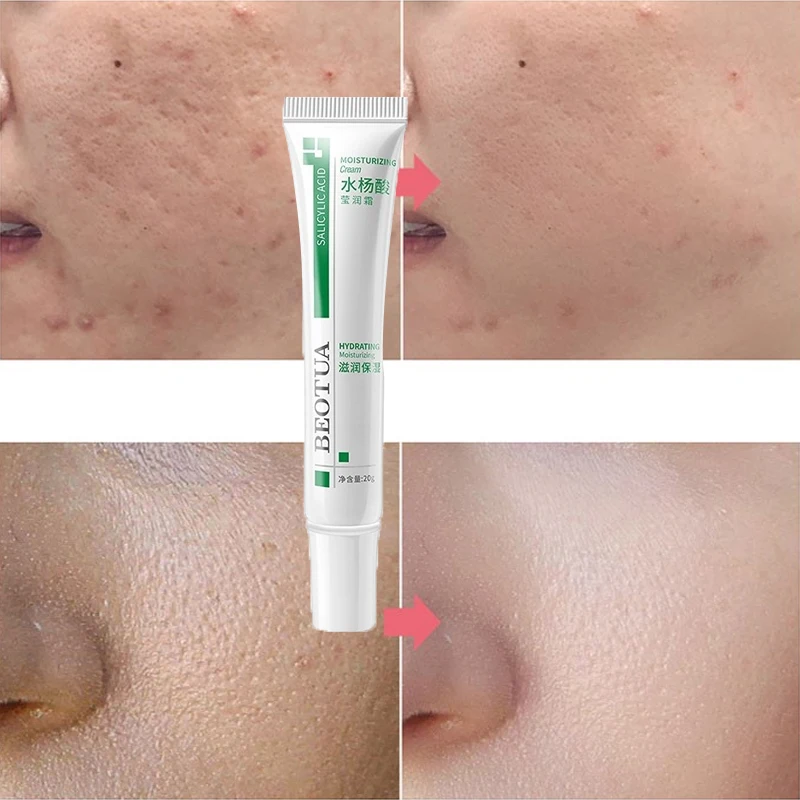 

20g Salicylic Acid Shrink Pores Face Cream Acne Treatment Remove Blackheads Oil Control Moisturizing Firm Whitening Skin Care