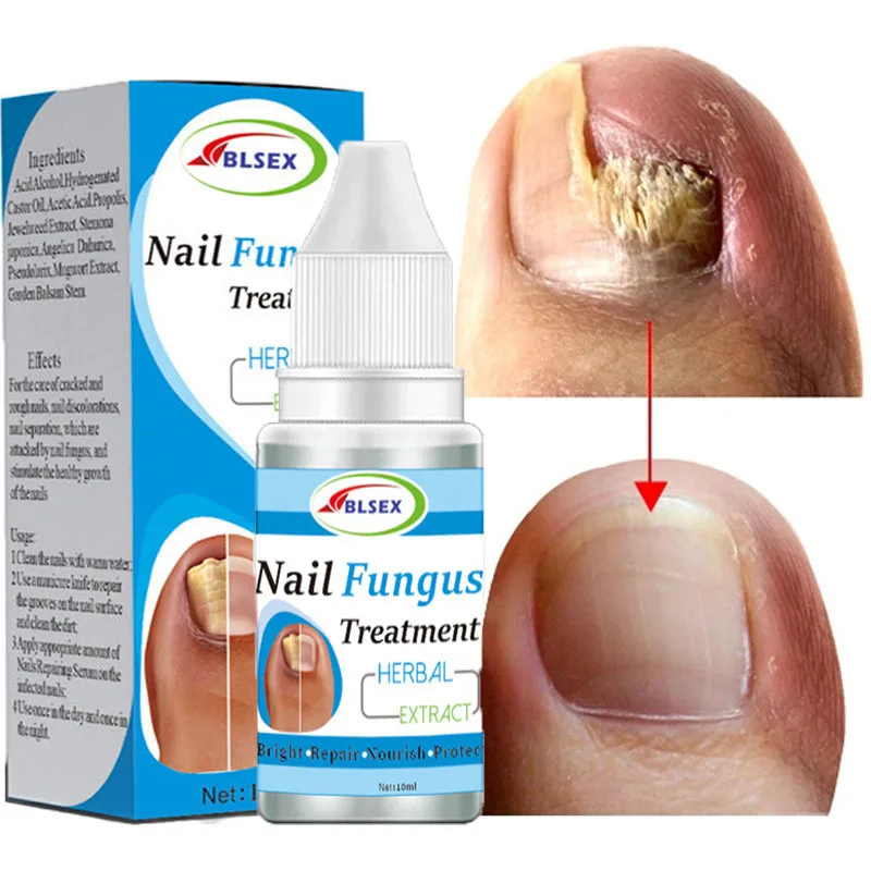 

Herbal Nail Fungus Treatment Serum Onychomycosis Paronychia Remover Essence Anti Infection Toe Nail Fungal Removal Products 10ml