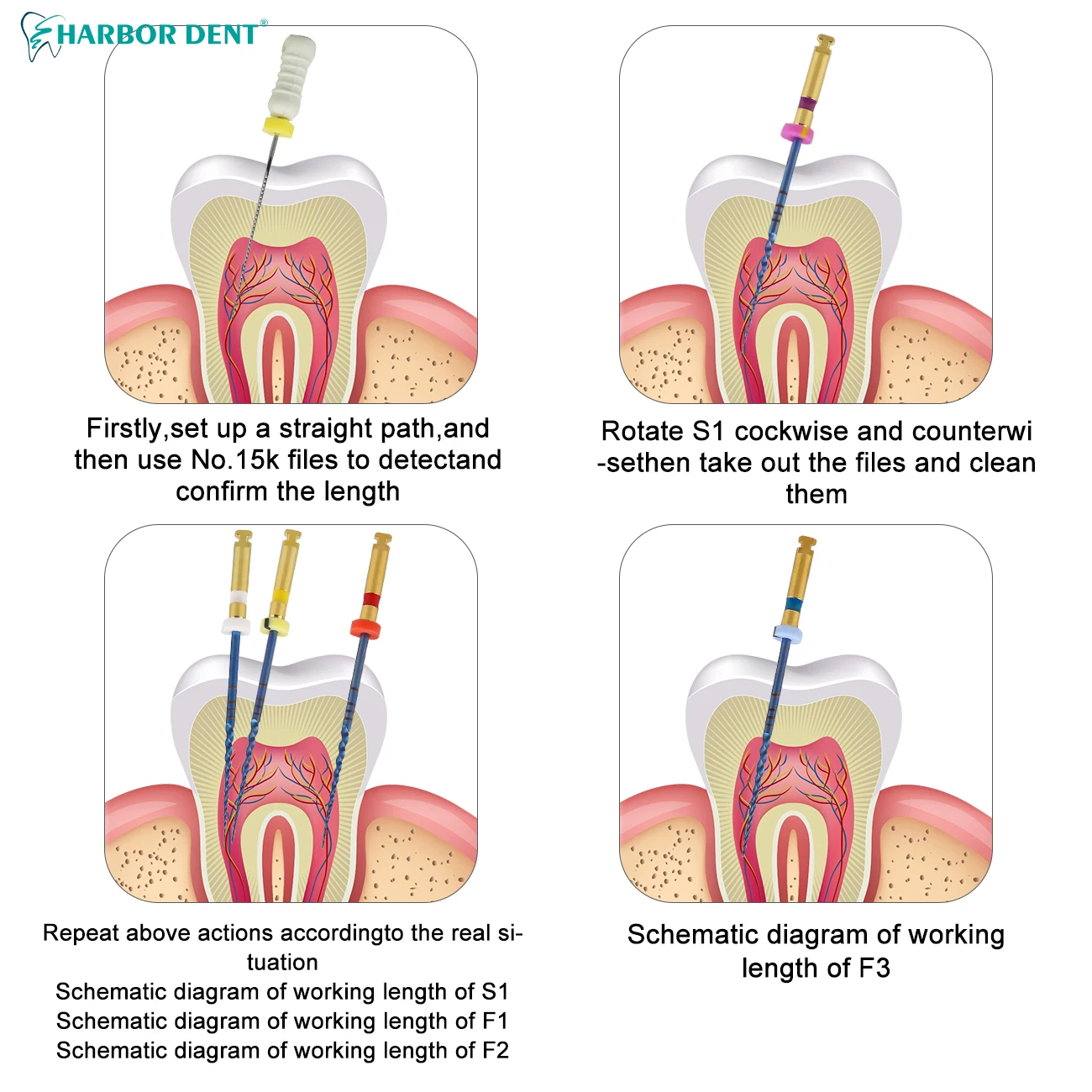 6 шт./кор. стоматологические SX-F3 синие файлы термоактивированные NiTi корневые для