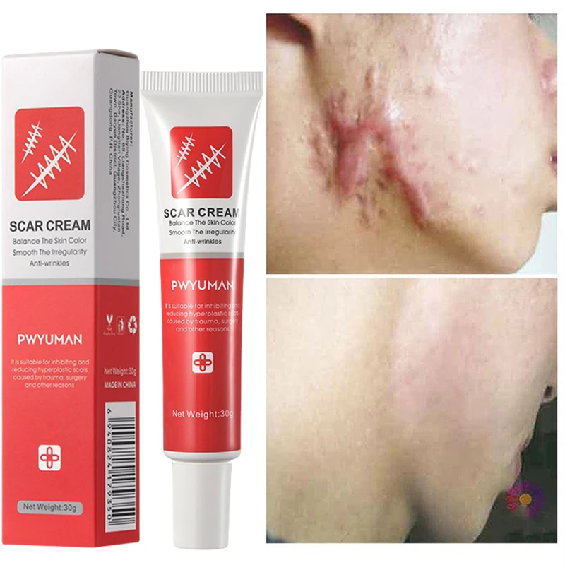 

Effective Scar Removal Cream Stretch Mark Acne Surgical Pimple Scar Treatment Gel Smooth Moisturizing Repair Face Body Skin Care