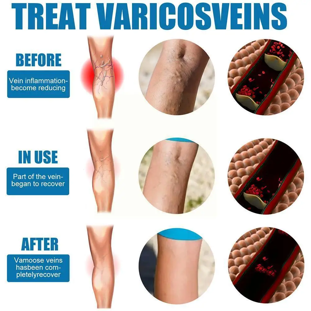 

Varicose Veins spray Medicine Spider Veins Treatment Care Medical Vasculitis Phlebitis Relief Relief Pain 30ml Plaster Spid I7F3