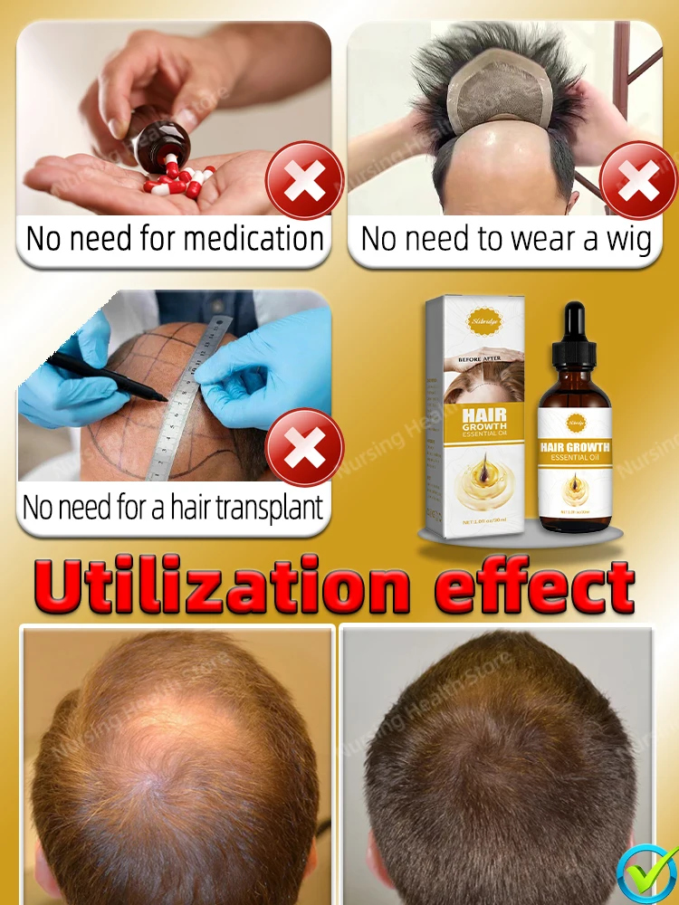 Sólo se necesitan 7 días para reparar la calvicie. El aceite esencial el crecimiento del cabello puede eficazmente