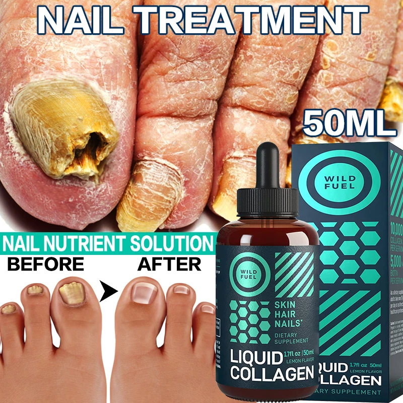 

Mosslay 50ml Fungal Nail Treatment Serum Foot Repair Essence Care Whitening Toe Nail Fungus Removal Gel Anti Infection