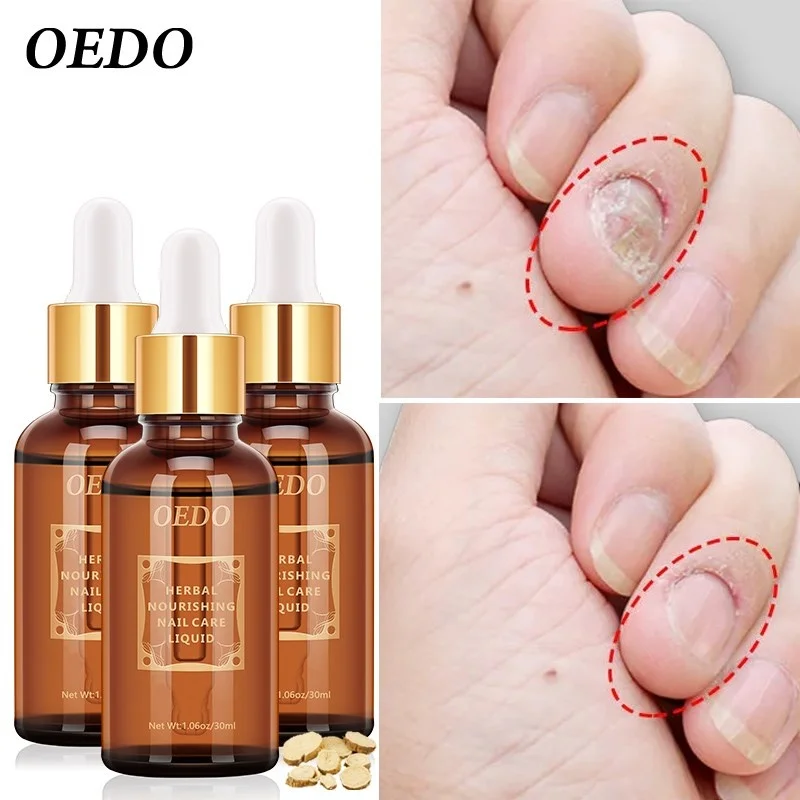 

OEDO Foot Nail Fungus Removal Fungal Nail Treatment Essential oil Anti Infection Paronychia Onychomycosis Hand Care Treat