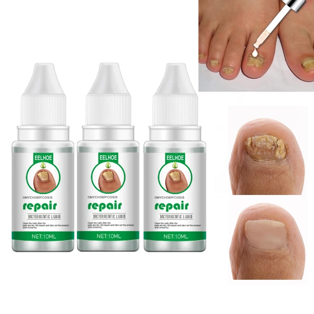 

Nail Repair Fluid Foot Care Serum Nail Fungus Toe Fungus Removal Gel Anti-Infective Paronychia Onychomycosis Repair