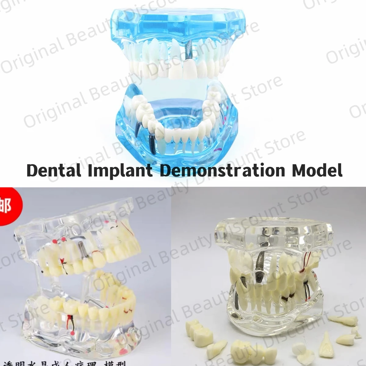 

Crystal Dental Implant Demonstration Model Teeth Study Teach Disease Analysis with Restoration Crown Bridge Maxillary Mandibular