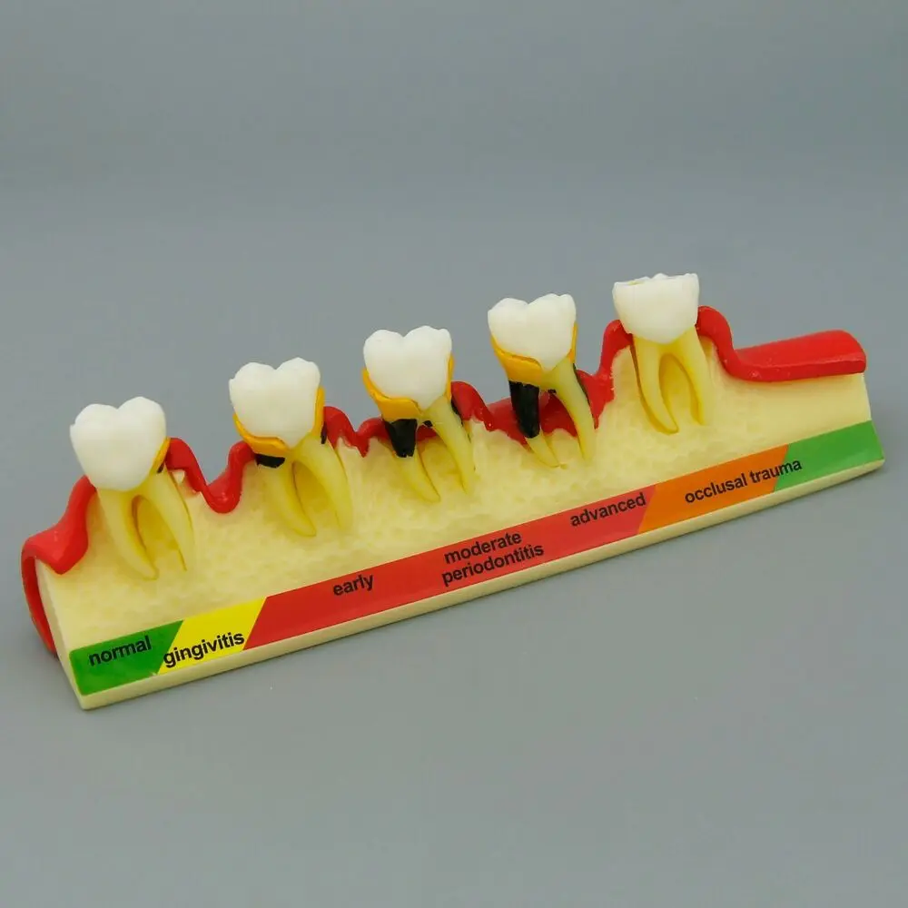 Dental Periodontal Disease Model 5 Stages Patient Education NISSIN Kilgore Style