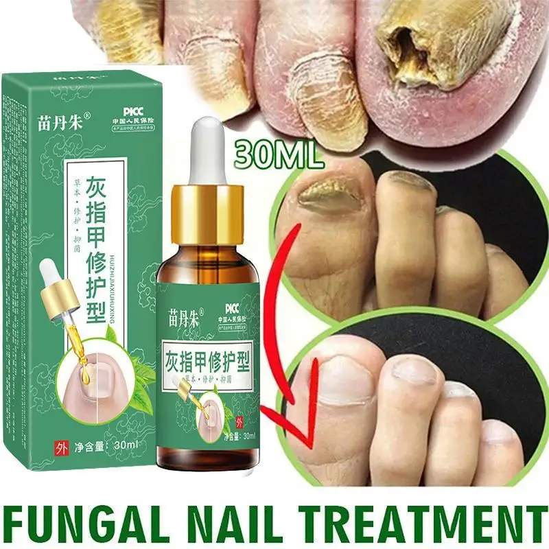 

Fungal Nail Treatment Oil Foot Repair Essence Toe Nail Gel 30ml Cream Fungal Removal Anti Fungus Infection Removal Nail B9J3