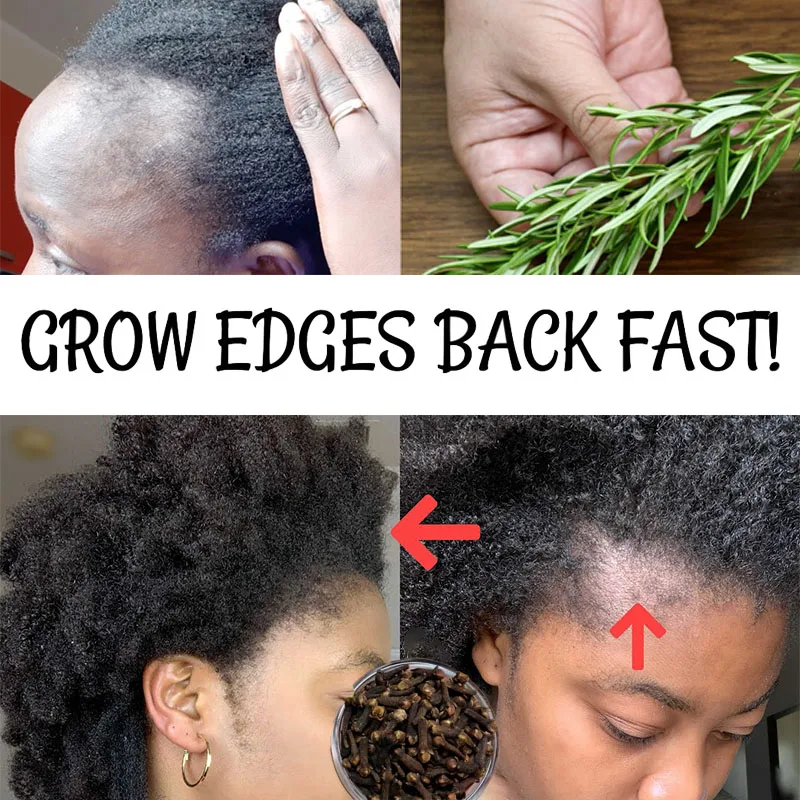 

Shampoo Against Hair Loss Rosemary for Growing Edge Back Get Rid of Traction Alopecia Improve Blood Circulation Increase Keratin