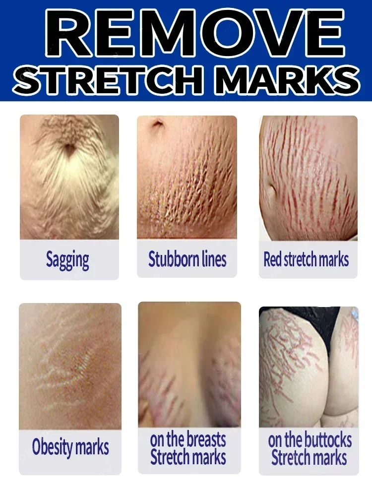 Спрей для растяжек на 7 дней беременных удаление после родов ожирение женский