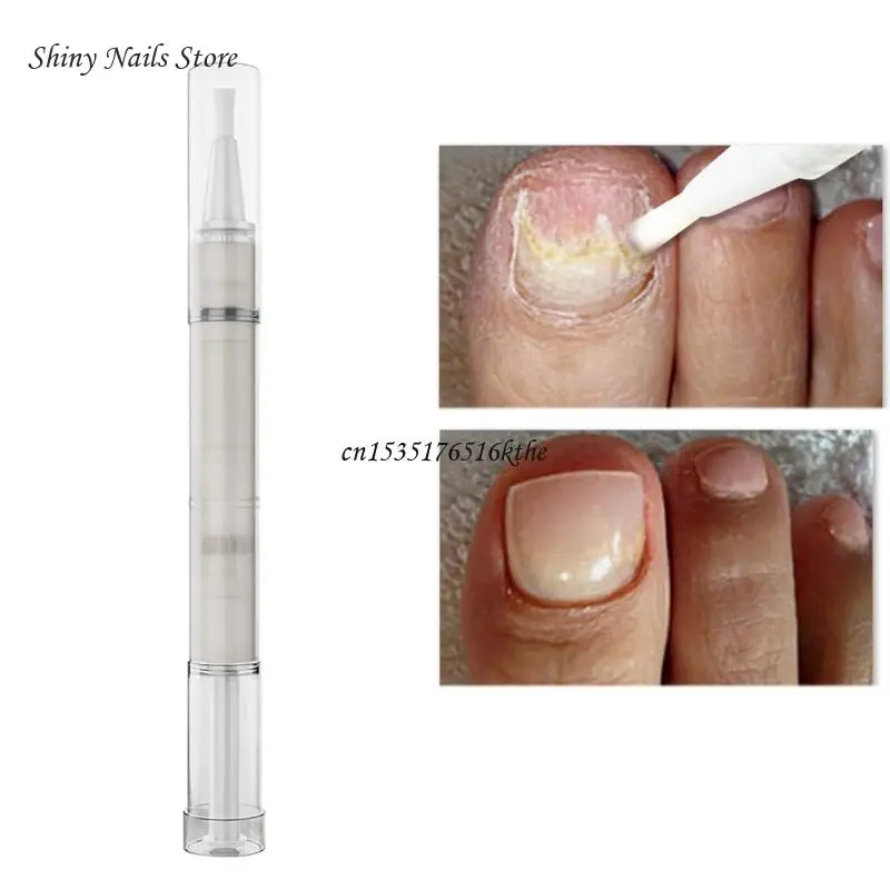 

4 мл противогрибковая ручка для ремонта ногтей онихомикоз паронихия китайский уход за ногтями на пальцах косметические процедуры