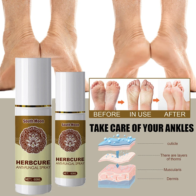 

Anti-Fungal Itching Foot Spray Natural Herbal Smelly Feet Treatment Health Care Athlete's Anti Infections New Foot Healthy Care